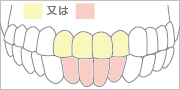 上顎前歯4本 or 下顎前歯4本