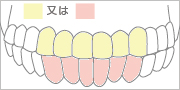 上顎前歯6本 or 下顎前歯6本